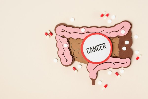 Prévention du cancer du colon : prenez quelques mesures en compte